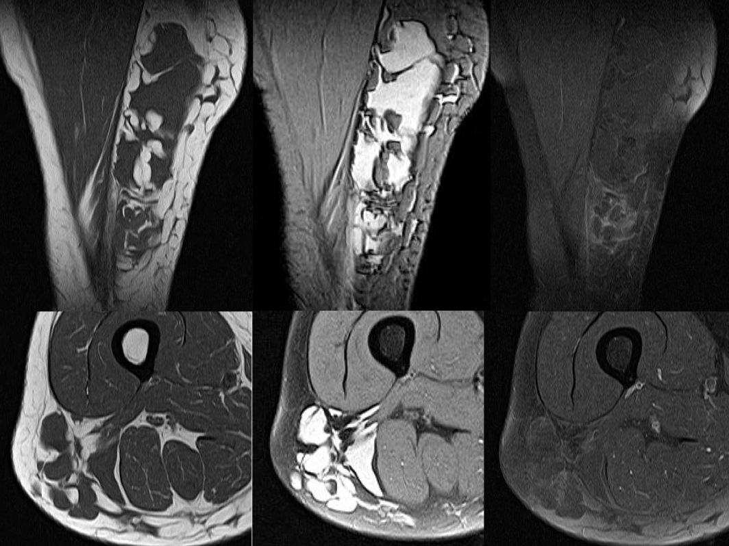 Figure 2 for case Hemangioma ( RID3969 )